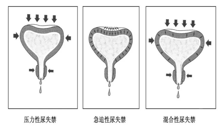 《成年女性压力性尿失禁护理干预》标准解读------中华护理学会老年专