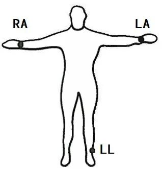 心电图机的肢体导联电极放置位置 心