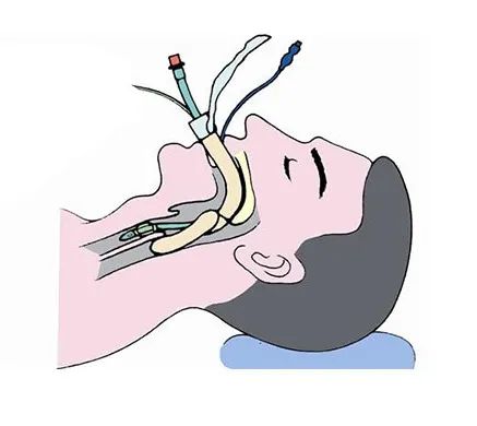 喉咙插管呼吸图片图片